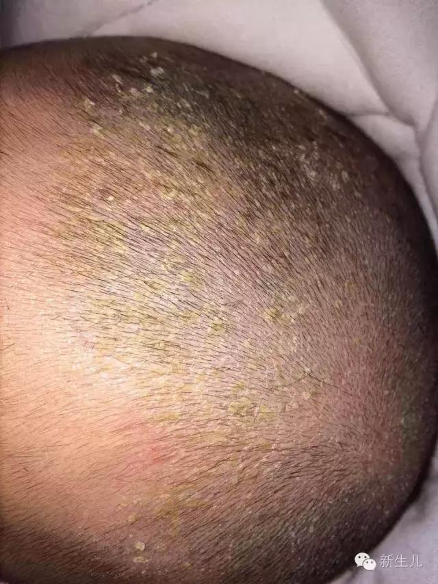 新生儿宝宝红疹子怎么引起的,新生儿皮肤起红疹子怎么办