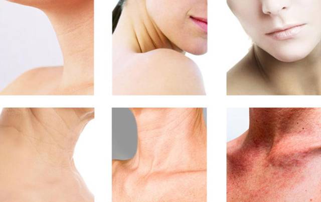 一条颈纹老十岁教你一招淡化,年纪小就有一条很深的颈纹