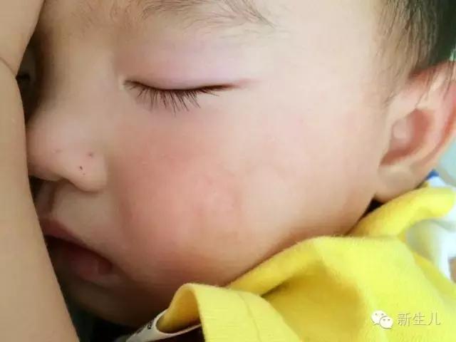 新生儿:婴儿皮肤起红疹?教你如何护理宝宝娇嫩的皮肤