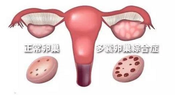 “痘妞”、“毛妹”,小心多囊卵巢综合征!(附靠谱的三甲医院名单)