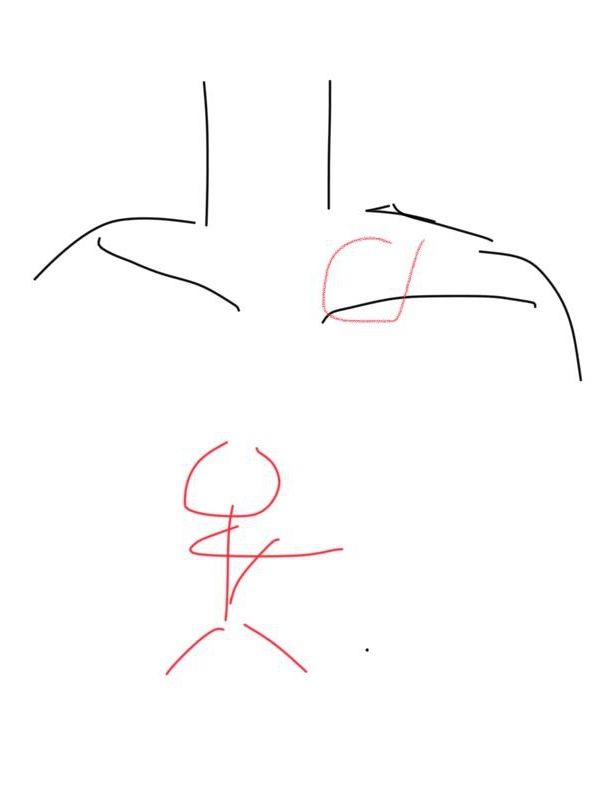 髌腱支持带在哪个位置,髌腱炎和髌腱末端病的区别