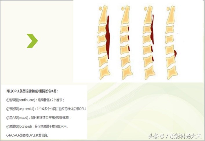 有些人颈椎病为什么那么严重,最可怕的颈椎病