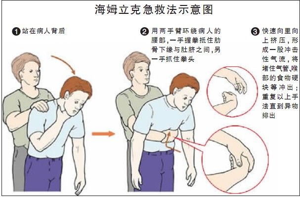 异物卡喉的急救方法婴儿,孕妇异物卡喉窒息时该怎么急救