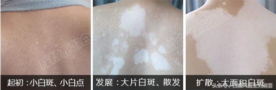 太阳晒后出现白癜风怎么修复,太阳晒伤会得白癜风吗