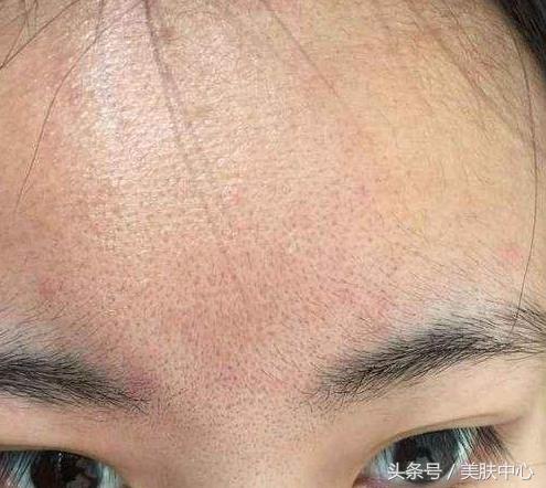 脸上毛孔老是堵塞用什么药膏,面部油脂过多毛孔堵塞怎么办