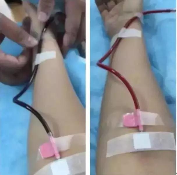 血管堵没堵看这里就知道了,吃肥肉容易堵血管吗