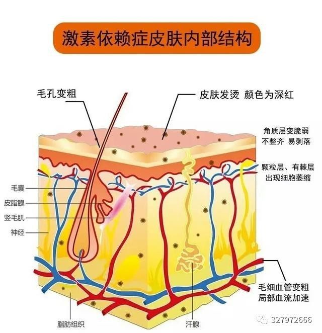激素脸发红发烫怎么能快速修复好,激素脸灼热要怎么治疗