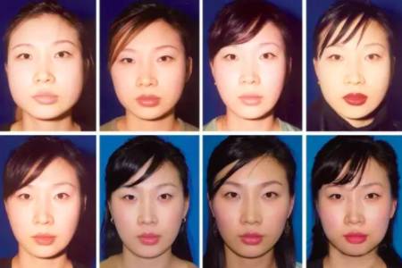 瘦脸针防止凹陷,瘦脸针注意避坑