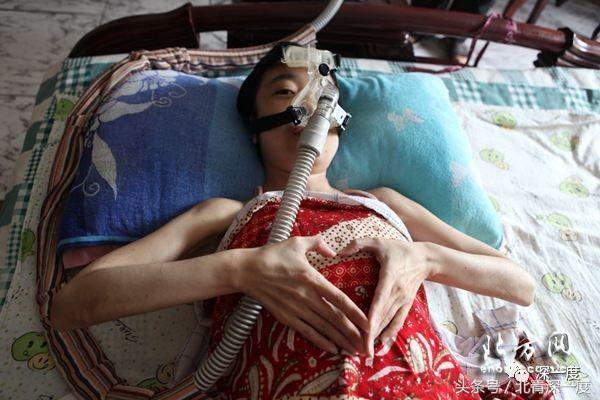 庞贝氏症这种病严重吗,庞贝氏症2018