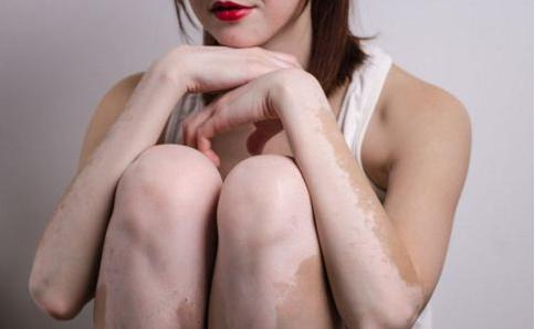 钱不是最重要的！白癜风患者做到*不五**缺，疾病就能早日痊愈