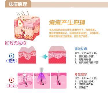 粉刺没有处理好变成硬疙瘩,痘痘粉刺消不掉