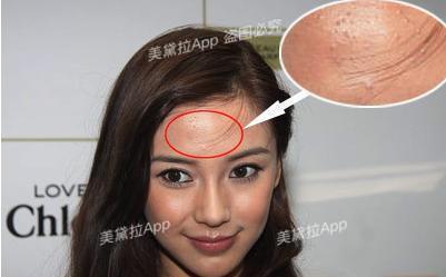 粉刺没有处理好变成硬疙瘩,痘痘粉刺消不掉