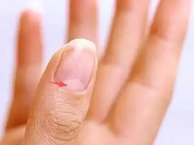 指甲竖纹变少了,指甲竖纹发白没血色