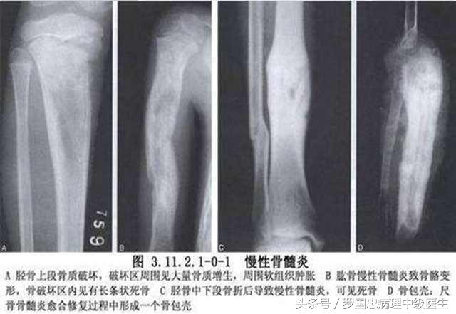 骨髓炎中药验方,骨髓炎医案