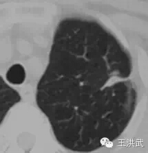 氩氦刀冷冻消融肿瘤,氩氦刀治疗肿瘤的风险