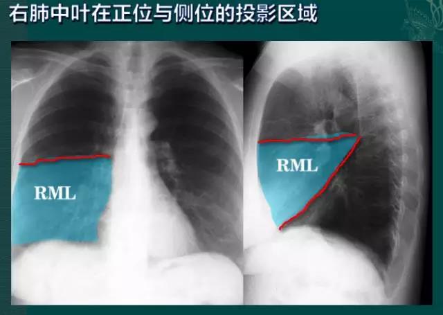 读完该文,让你学会如何看胸片
