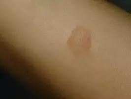 接触得了猫癣的猫会怎么办,猫舍猫普遍得猫癣了怎么办