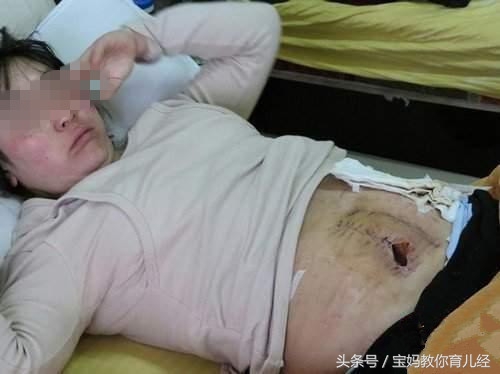 剖腹产半年意外怀孕婆婆跪求留下,剖腹产后出院婆婆哭了