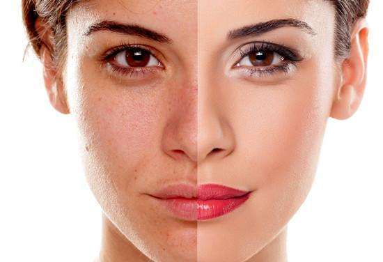 痘痘爆发的10大影响因素,痘痘一直不好因为做错了这几件事