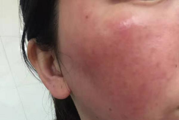 激素脸反复起红疹痒怎么办,激素脸出红疹子怎么办