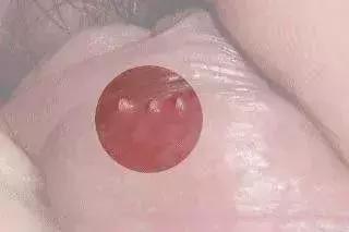 蛋蛋长痘痘？长疙瘩？当心变成“坏蛋”！