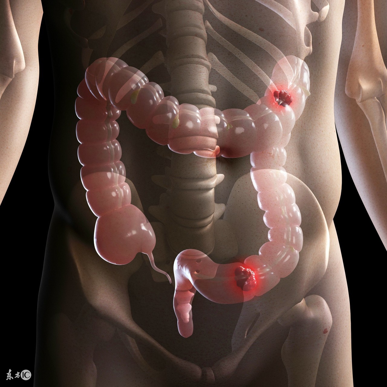 便血如何分辨是痔疮还是肠癌,便血怎么判断是痔疮还是肠癌