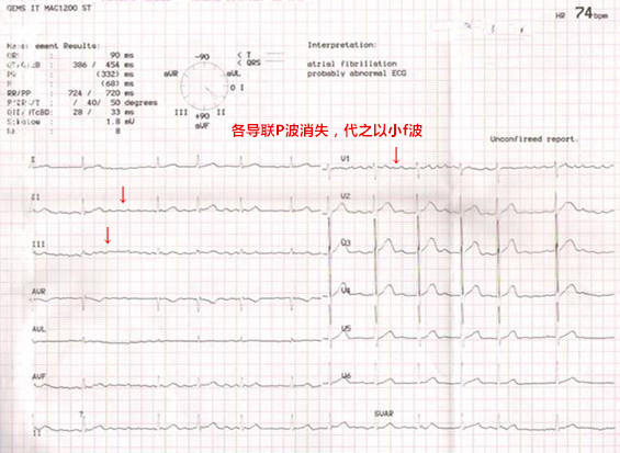 心房颤动是房颤吗,心房颤动的危害