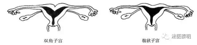 三胞胎在一个子宫吗,三胎双胞胎单角子宫