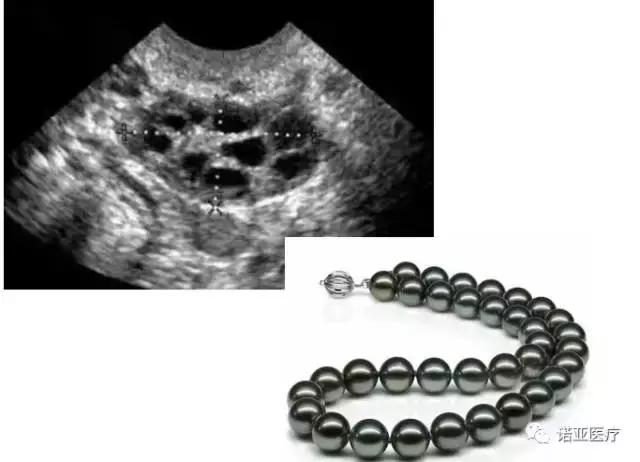 肥胖导致内分泌失调月经紊乱,月经不规律多毛怎么办