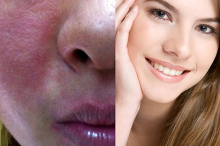 修复角质层薄红血丝敏感肌护肤品,皮肤角质层薄脸发红用什么药修复