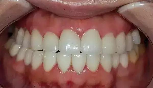 做烤瓷牙后悔的人,做烤瓷牙的人都后悔吗