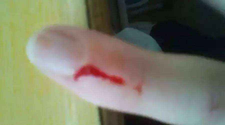 营养不良会导致手术切口不愈合吗,营养不良补不回来怎么办