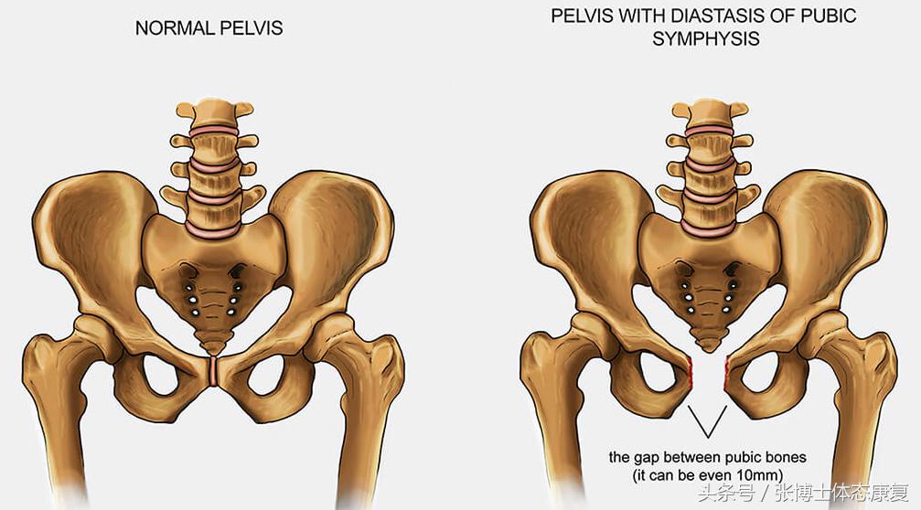 耻骨联合痛康复动作,耻骨分离产后走路超级疼怎么缓解