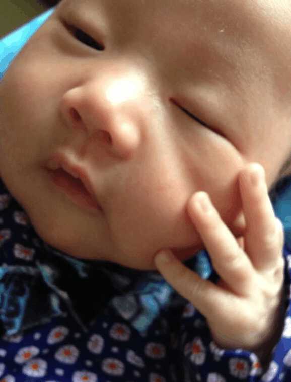 3个月的小宝宝容易长湿疹,刚出生宝宝一脸湿疹