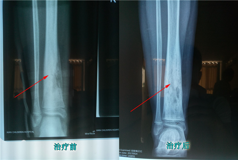 治疗骨髓炎中医高手,骨髓炎怎么彻底治疗