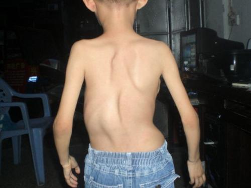 儿童脊椎侧弯自我纠正方法,儿童脊柱侧弯还能自己长直吗