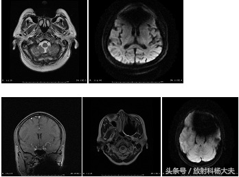 想做脑部核磁但有固定假牙怎么办,做核磁需要把金属假牙拔掉吗