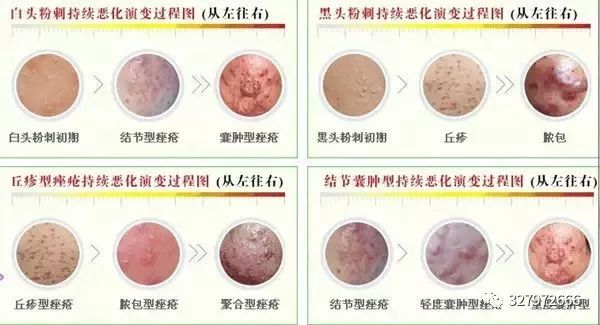 黑头痘痘粉刺去除过程护理,巨大粉刺型痘痘怎么治疗