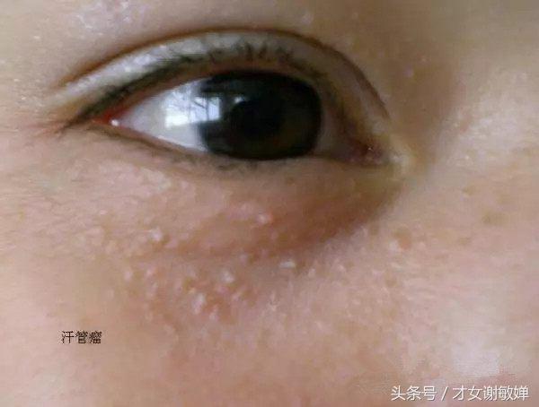 护肤处理闭合粉刺,谢敏婵的护肤品