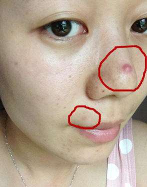 女性外面长了小痘,外面长什么痘里面就有什么病