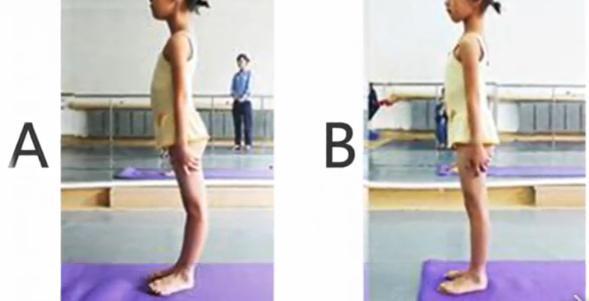 膝盖过伸如何矫正锻炼的图解,膝盖超伸怎么矫正腿型