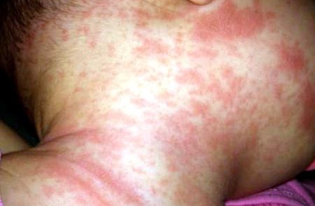 婴儿脸上疹子,婴儿疹子