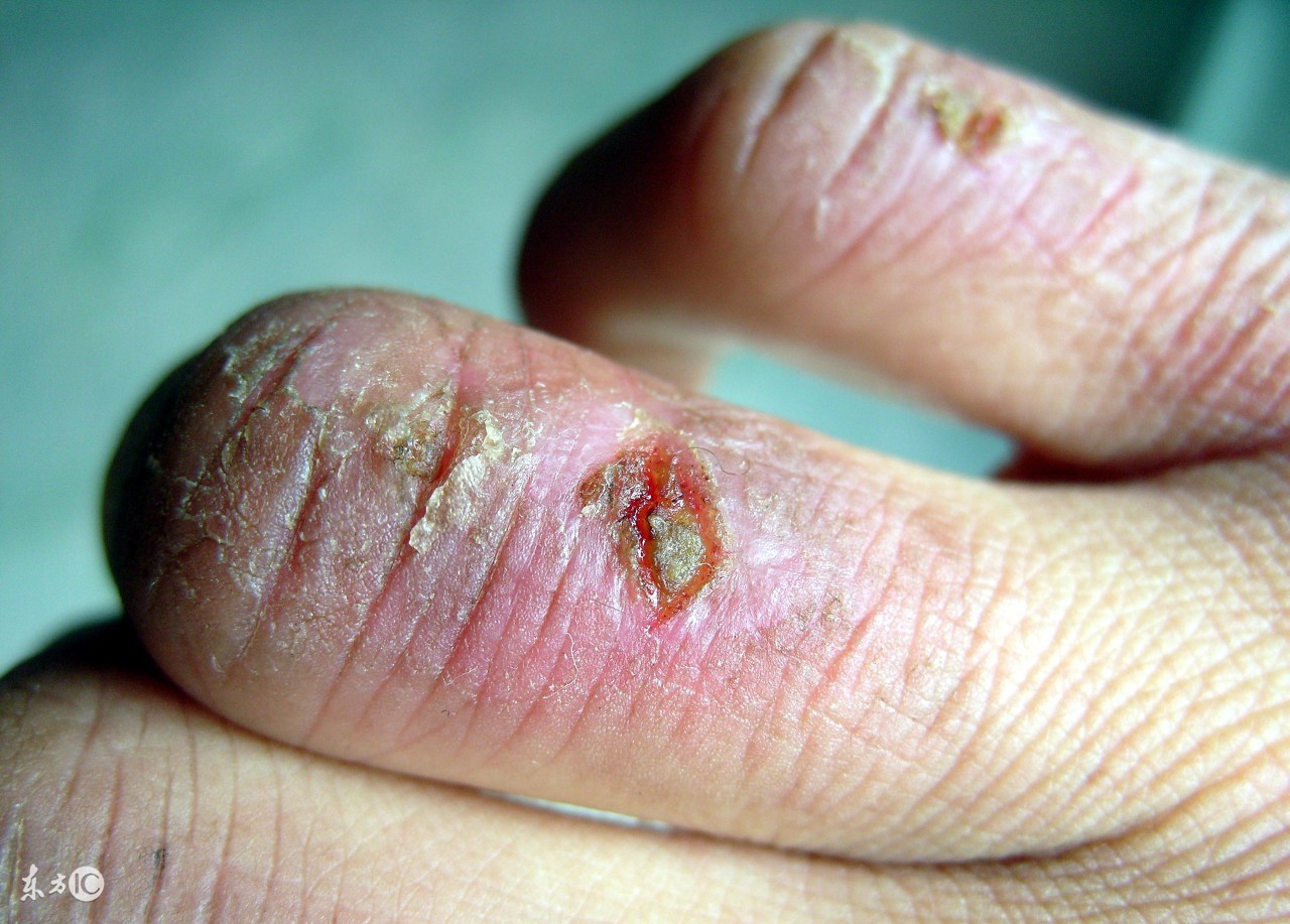 冻疮的症状用药原则及代表药物,如何预防冻疮不复发偏方