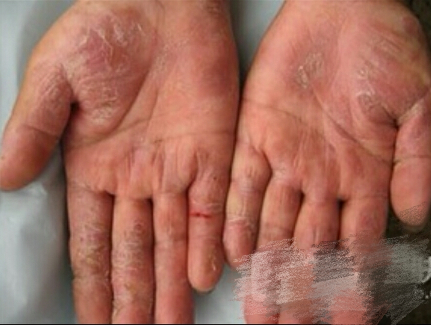 患有手足皲裂（裂口子）症的亲，最值得收藏哟