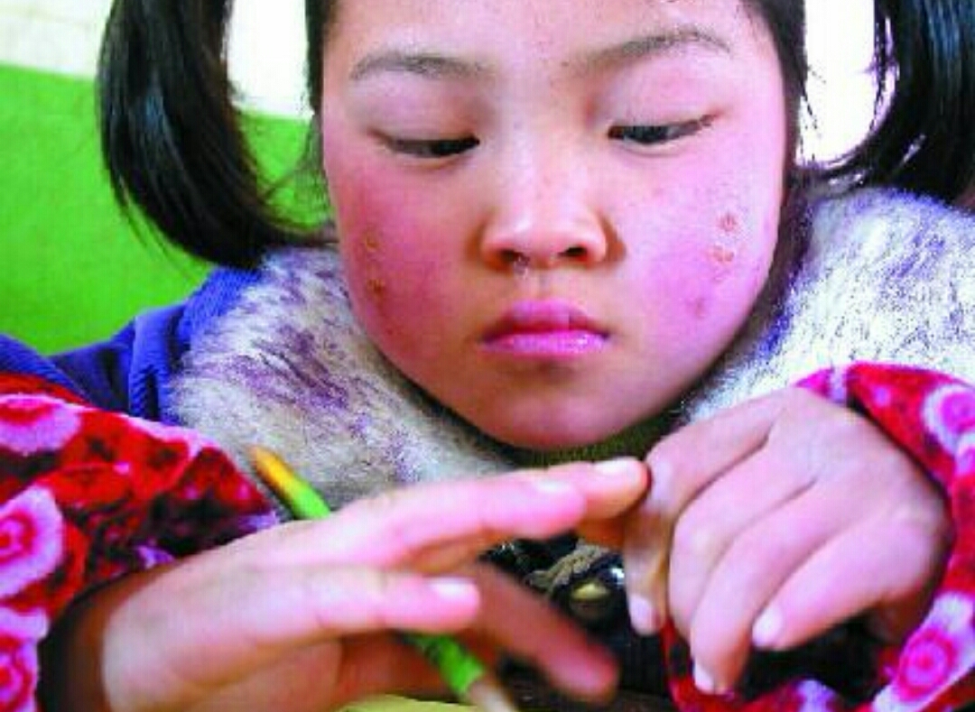 冻伤疮什么意思,冻疮的治疗方法