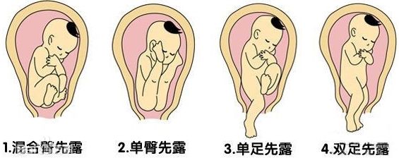 产科夜班之遇上不产检的急诊孕妇