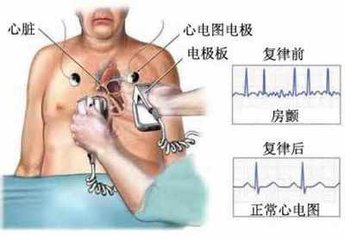 心脏房颤治疗需要多少钱,电复律治疗房颤对心脏有损害吗