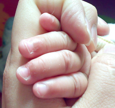 6个月婴儿手上长倒刺涂什么,宝宝手上起倒刺手指头起皮