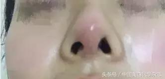 隆鼻做的越简单恢复的越快么,隆鼻十年了有点透光怎么修复