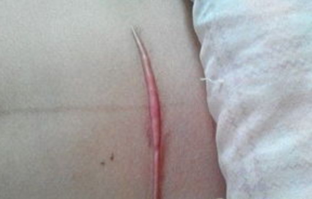 女人剖腹产两年疤痕痒痒,剖腹产20天后刀口疤痕发红发痒